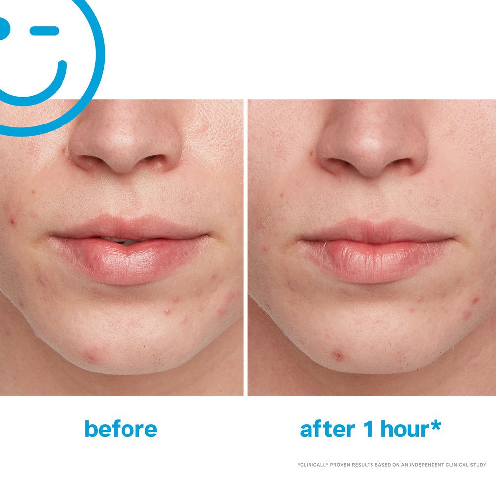 Kate Somerville EradiKate Acne Treatment 1oz