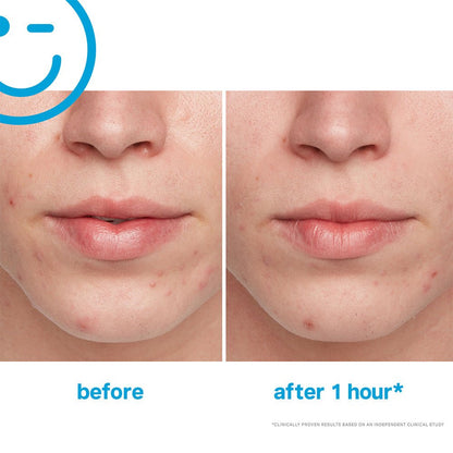 Kate Somerville EradiKate Acne Treatment 1oz