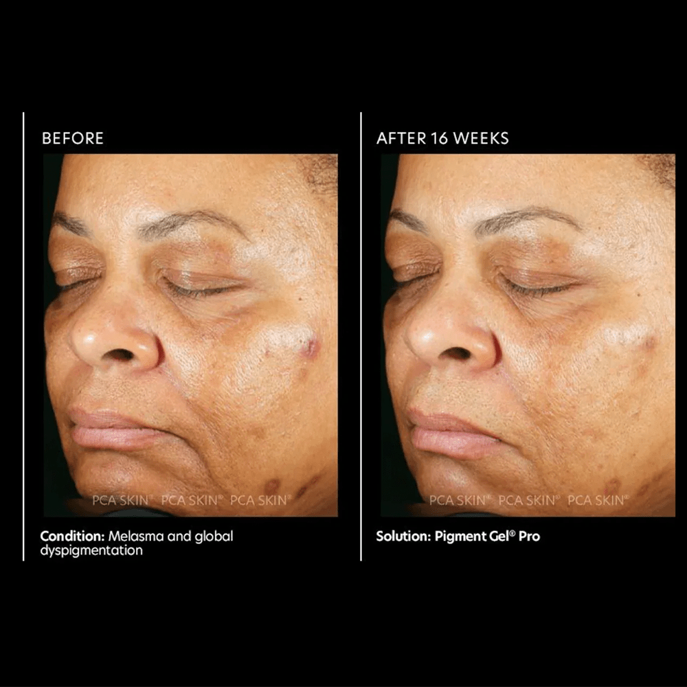 PCA Pigment Gel® Pro 29ml